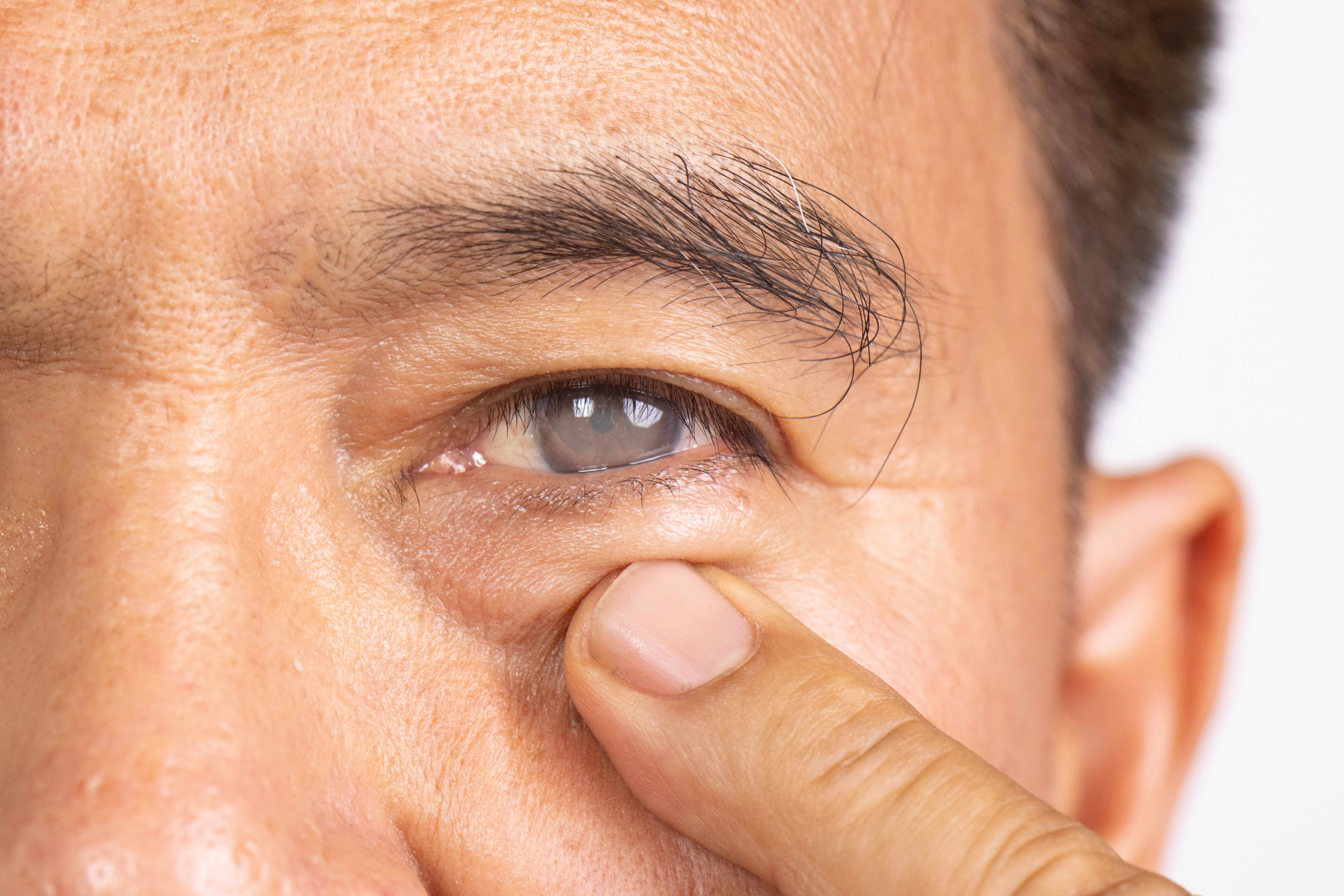 A close up of an old man's face, pointing at his left eye which has visible cataracts.
